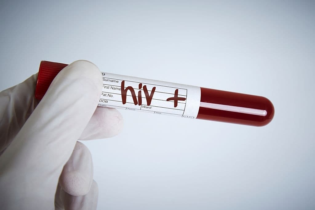 تشخيص أعراض الإيدز بتحليل الدم