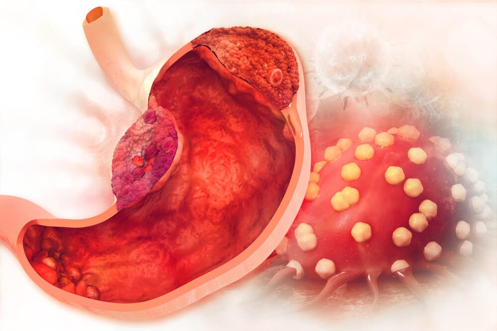 أعراض سرطان المعدة وأسباب الأصابة والمراحل دوت طب