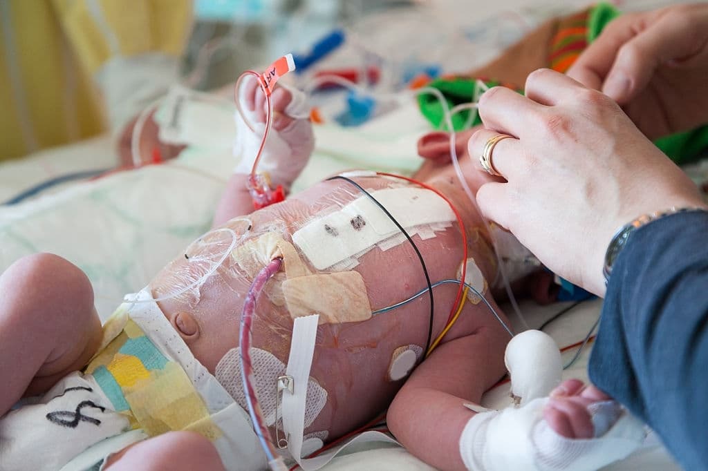 عملية القلب المفتوح للأطفال الرضع